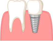 Один имплант